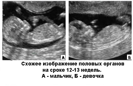 Фото Узи Беременности Мальчика